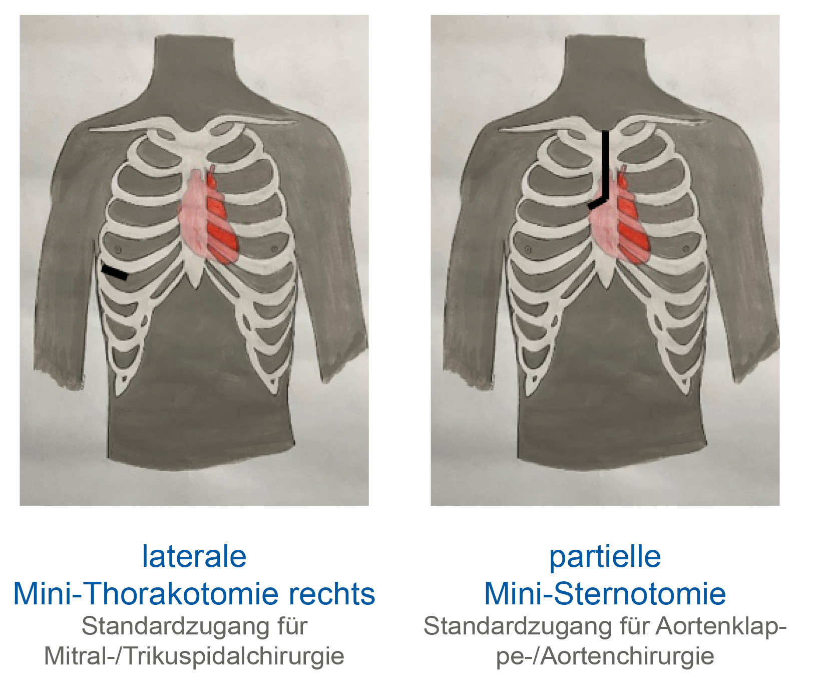 Herzklappenchirurgie - Klinikum Fulda